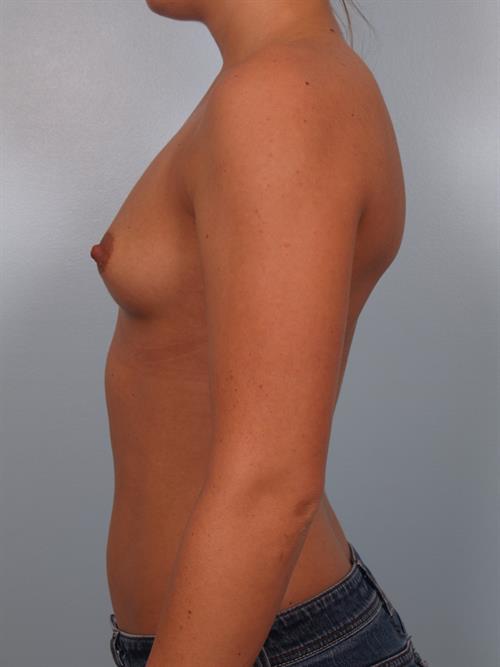 Breast Augmentation Before Photo | Phoenix and Scottsdale, AZ | Scottsdale Center for Plastic Surgery