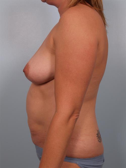 Tummy Tuck Before Photo | Phoenix and Scottsdale, AZ | Scottsdale Center for Plastic Surgery