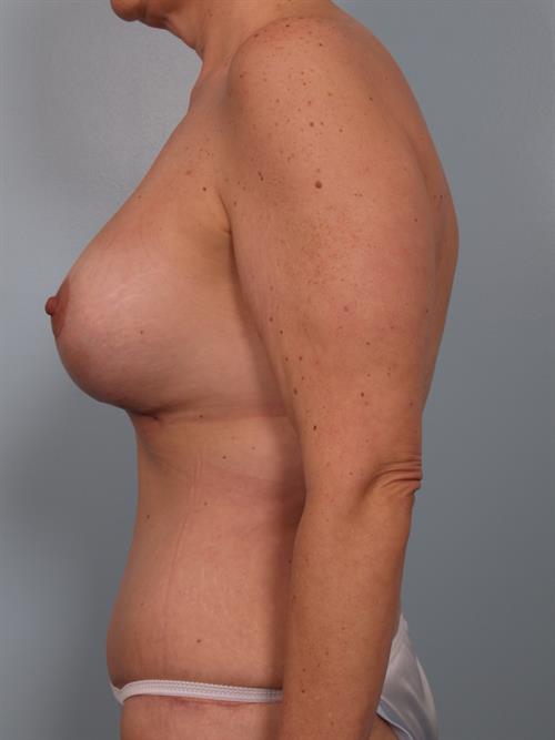 Revision Breast Surgery After Photo | ,  | 