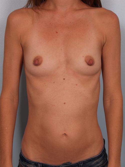 Breast Augmentation Before Photo | Phoenix and Scottsdale, AZ | Scottsdale Center for Plastic Surgery