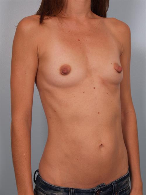 Breast Augmentation Before Photo | Phoenix and Scottsdale, AZ | Scottsdale Center for Plastic Surgery