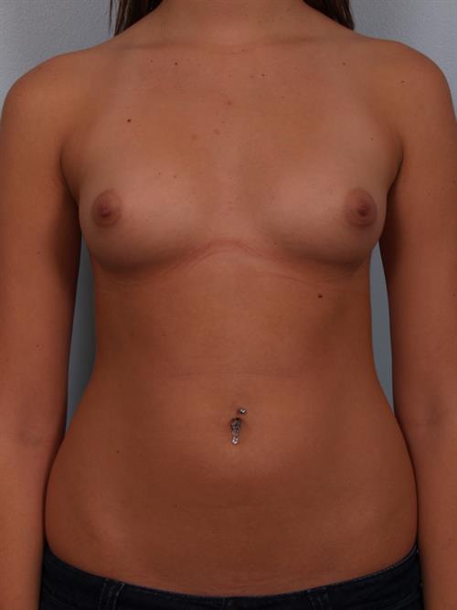 Breast Augmentation Before Photo | Phoenix and Scottsdale, AZ | Scottsdale Center for Plastic Surgery