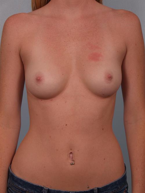 Breast Augmentation Before Photo | Phoenix and Scottsdale, AZ | Scottsdale Center for Plastic Surgery