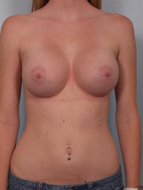 Breast Augmentation After Photo | Phoenix and Scottsdale, AZ | Scottsdale Center for Plastic Surgery