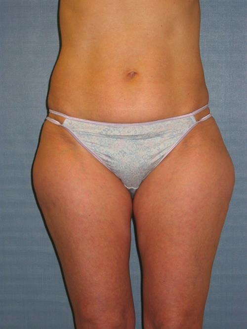 Power Assisted Liposuction Before Photo | Phoenix and Scottsdale, AZ | Scottsdale Center for Plastic Surgery