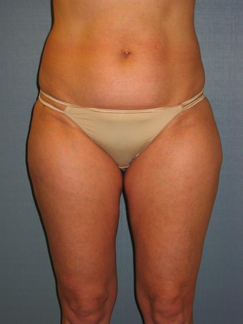 Power Assisted Liposuction After Photo | Phoenix and Scottsdale, AZ | Scottsdale Center for Plastic Surgery