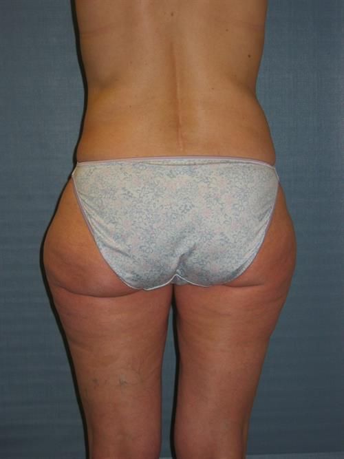 Power Assisted Liposuction Before Photo | Phoenix and Scottsdale, AZ | Scottsdale Center for Plastic Surgery