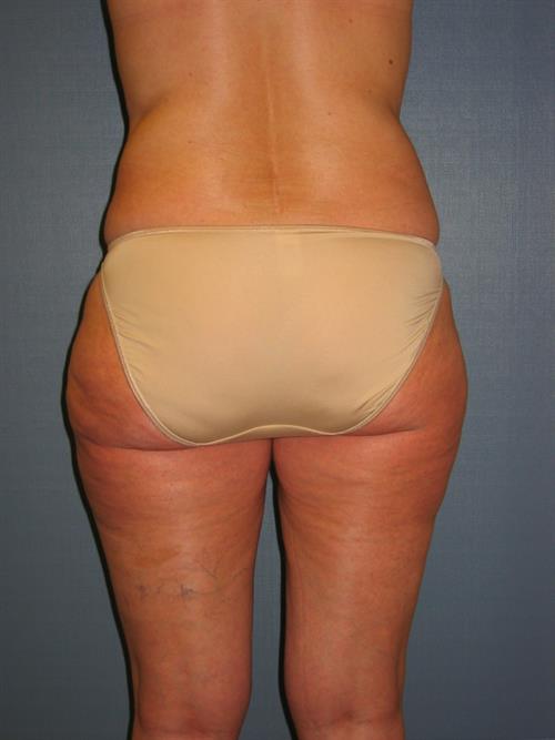 Power Assisted Liposuction After Photo | Phoenix and Scottsdale, AZ | Scottsdale Center for Plastic Surgery