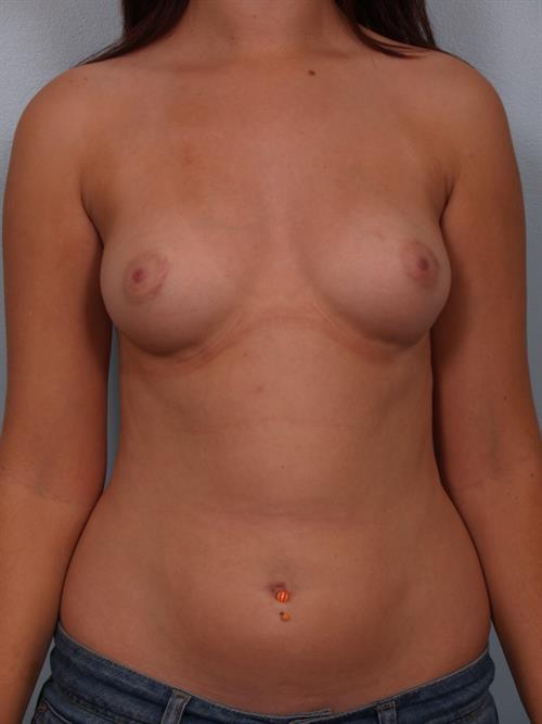 Breast Augmentation Before Photo | Phoenix and Scottsdale, AZ | Scottsdale Center for Plastic Surgery