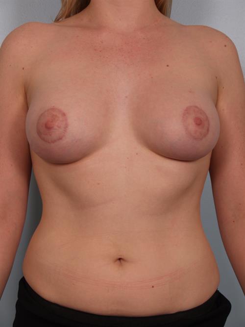 Breast Augmentation After Photo | Phoenix and Scottsdale, AZ | Scottsdale Center for Plastic Surgery