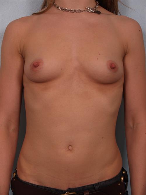 Breast Augmentation Before Photo | Phoenix and Scottsdale, AZ | Scottsdale Center for Plastic Surgery