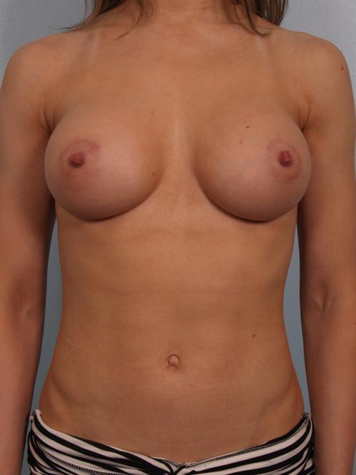 Breast Augmentation After Photo | Phoenix and Scottsdale, AZ | Scottsdale Center for Plastic Surgery