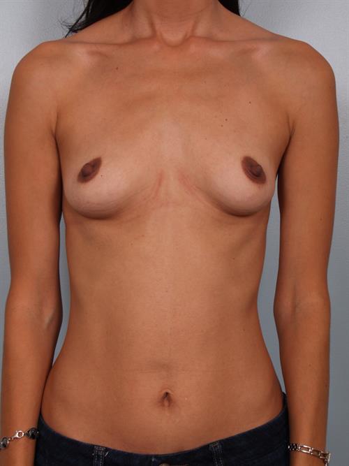 Breast Augmentation Before Photo | Phoenix and Scottsdale, AZ | Scottsdale Center for Plastic Surgery