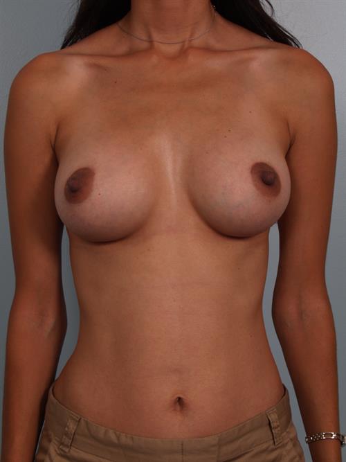 Breast Augmentation After Photo | Phoenix and Scottsdale, AZ | Scottsdale Center for Plastic Surgery