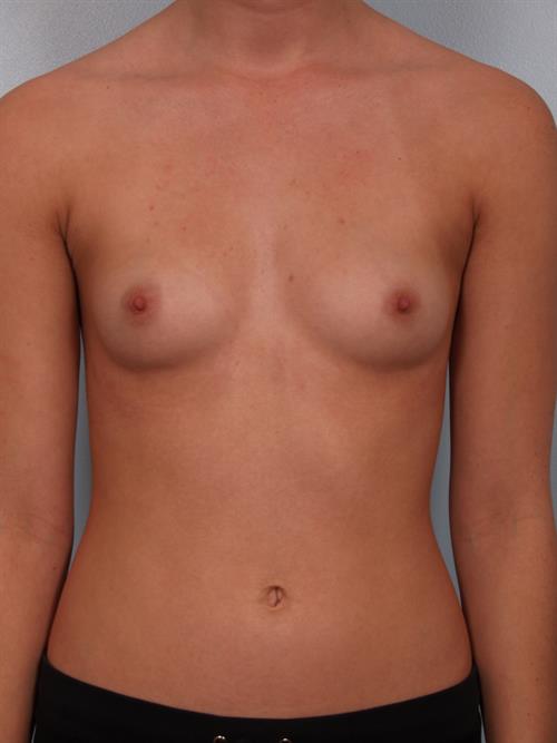 Breast Augmentation Before Photo | Phoenix and Scottsdale, AZ | Scottsdale Center for Plastic Surgery