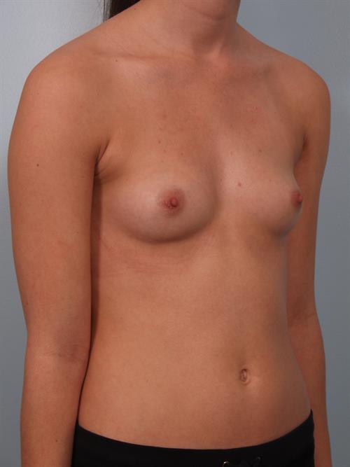 Breast Augmentation Before Photo | Phoenix and Scottsdale, AZ | Scottsdale Center for Plastic Surgery