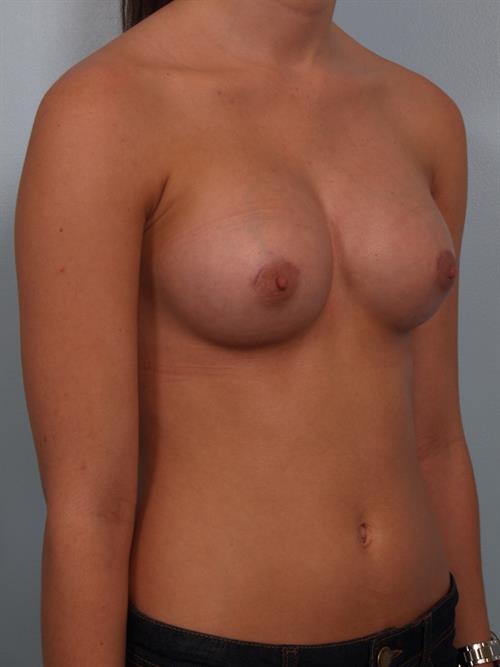 Breast Augmentation After Photo | Phoenix and Scottsdale, AZ | Scottsdale Center for Plastic Surgery