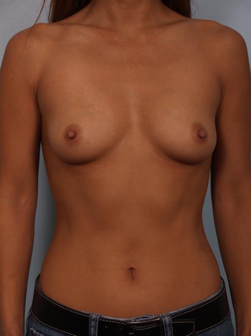 Breast Augmentation Before Photo | Phoenix and Scottsdale, AZ | Scottsdale Center for Plastic Surgery