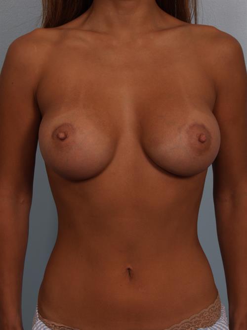 Breast Augmentation After Photo | Phoenix and Scottsdale, AZ | Scottsdale Center for Plastic Surgery