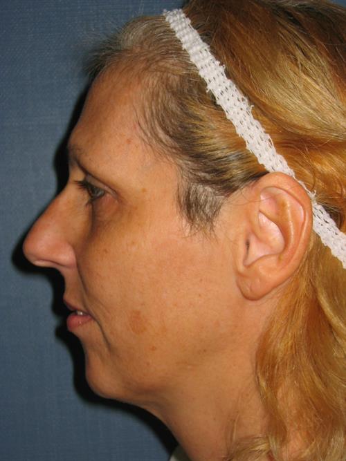 Chin Augmentation Before Photo | Phoenix and Scottsdale, AZ | Scottsdale Center for Plastic Surgery