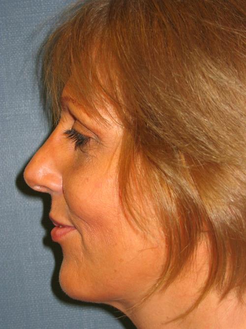 Chin Augmentation After Photo | Phoenix and Scottsdale, AZ | Scottsdale Center for Plastic Surgery