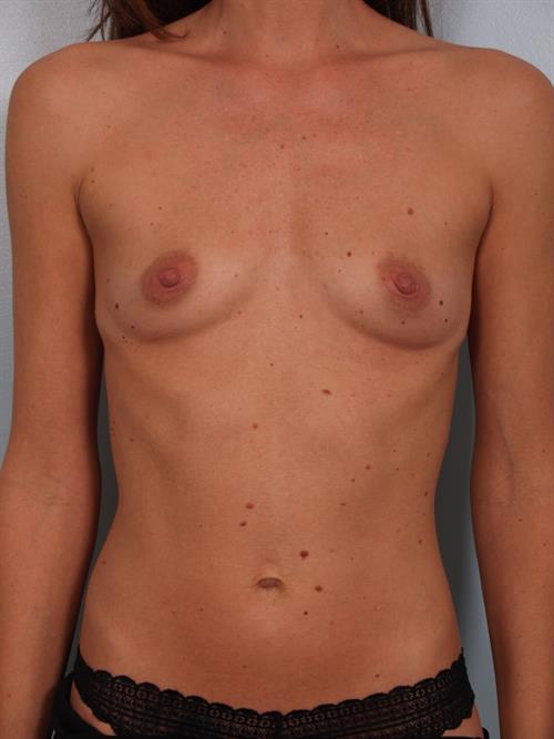 Breast Augmentation Before Photo | Phoenix and Scottsdale, AZ | Scottsdale Center for Plastic Surgery