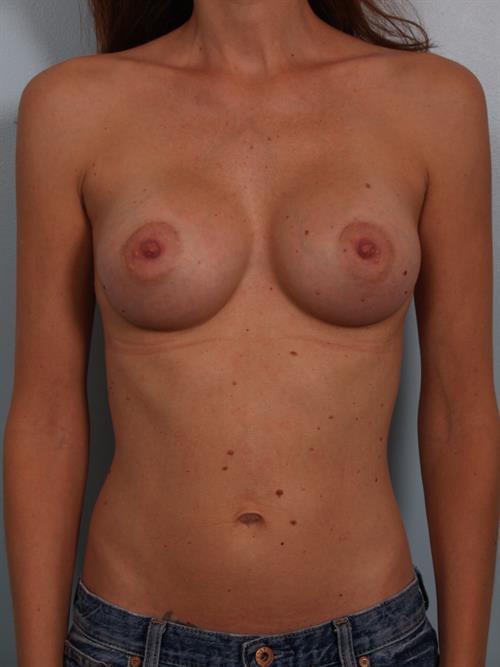 Breast Augmentation After Photo | Phoenix and Scottsdale, AZ | Scottsdale Center for Plastic Surgery