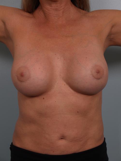 Revision Breast Surgery After Photo | Phoenix and Scottsdale, AZ | Scottsdale Center for Plastic Surgery