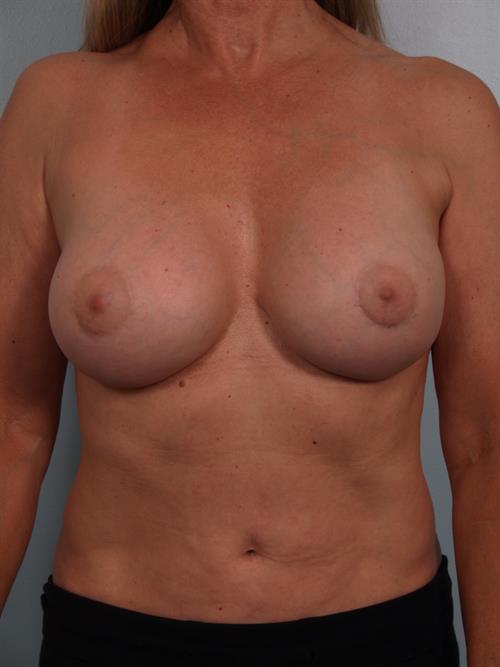 Revision Breast Surgery After Photo | Phoenix and Scottsdale, AZ | Scottsdale Center for Plastic Surgery