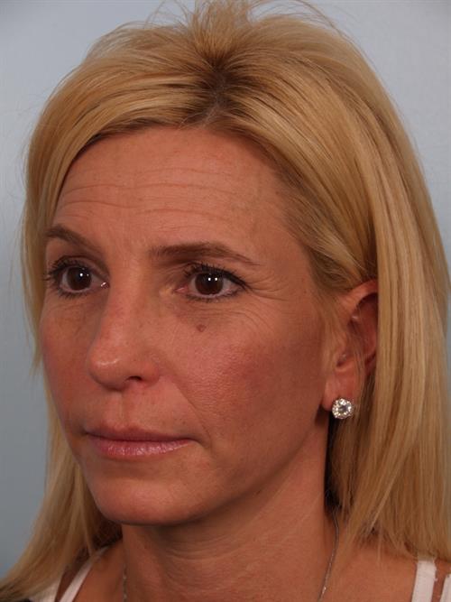 Brow Lift Before Photo | Phoenix and Scottsdale, AZ | Scottsdale Center for Plastic Surgery
