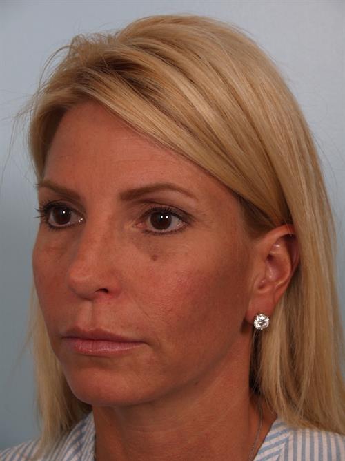 Brow Lift After Photo | Phoenix and Scottsdale, AZ | Scottsdale Center for Plastic Surgery