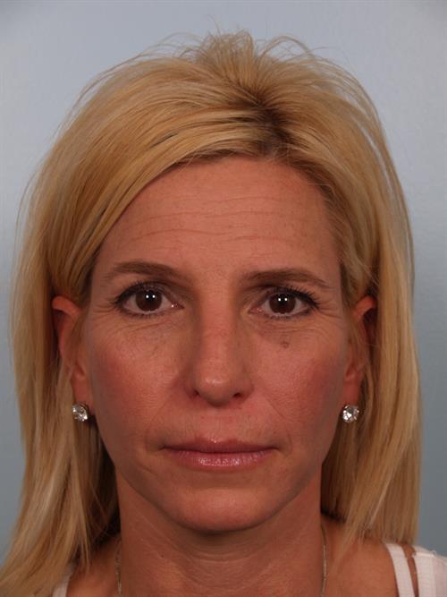Botox Before Photo | Phoenix and Scottsdale, AZ | Scottsdale Center for Plastic Surgery