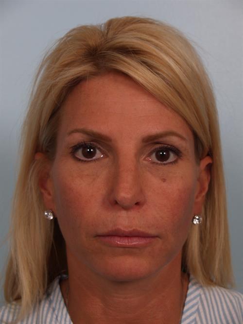 Botox After Photo | Phoenix and Scottsdale, AZ | Scottsdale Center for Plastic Surgery