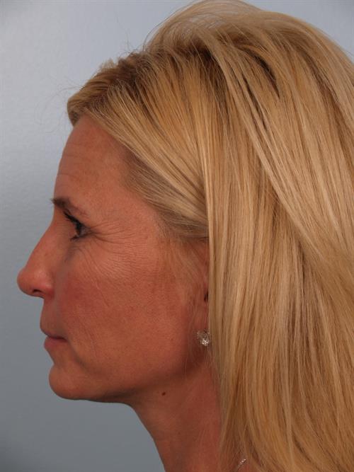 Brow Lift Before Photo | Phoenix and Scottsdale, AZ | Scottsdale Center for Plastic Surgery