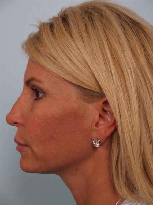 Brow Lift After Photo | Phoenix and Scottsdale, AZ | Scottsdale Center for Plastic Surgery