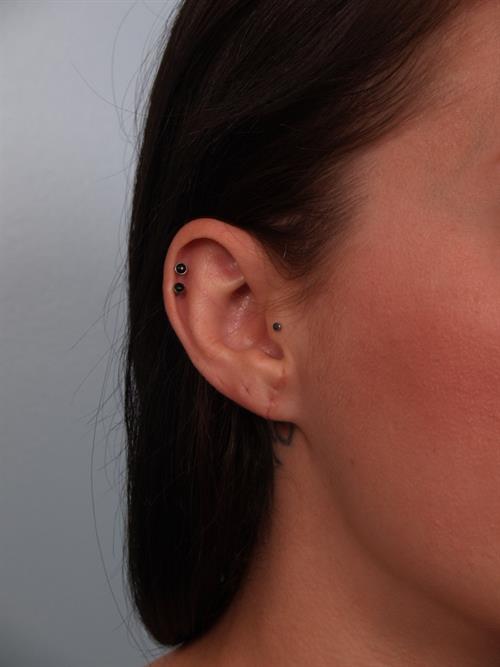 Otoplasty (Ear Reshaping) After Photo | Phoenix and Scottsdale, AZ | Scottsdale Center for Plastic Surgery