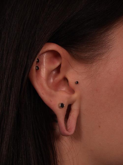 Otoplasty (Ear Reshaping) Before Photo | Phoenix and Scottsdale, AZ | Scottsdale Center for Plastic Surgery