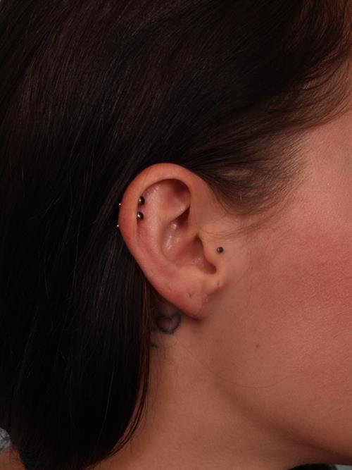 Otoplasty (Ear Reshaping) After Photo | Phoenix and Scottsdale, AZ | Scottsdale Center for Plastic Surgery