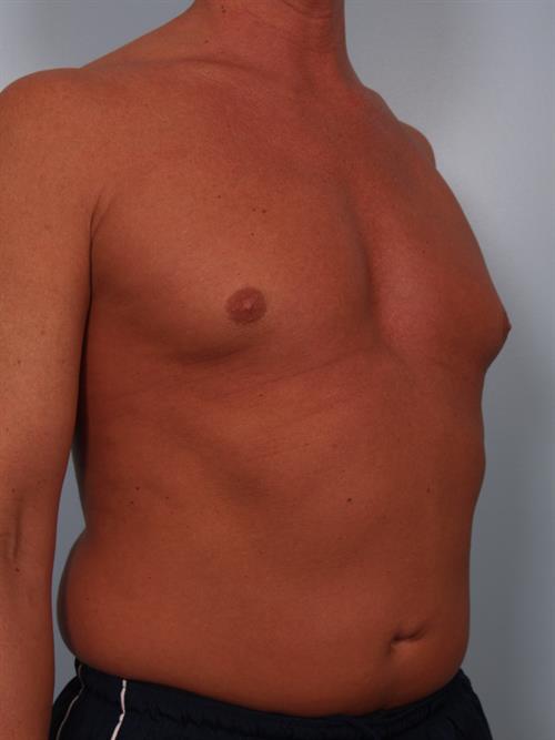 Male Breast/Areola Reduction Before Photo | Phoenix and Scottsdale, AZ | Scottsdale Center for Plastic Surgery