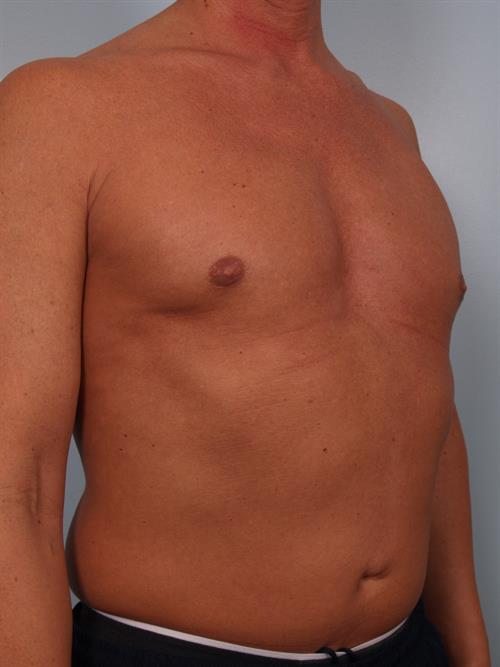 Male Breast/Areola Reduction After Photo | Phoenix and Scottsdale, AZ | Scottsdale Center for Plastic Surgery