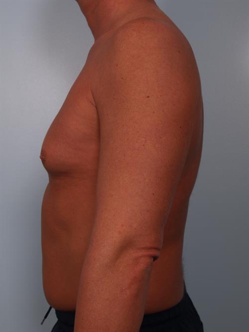 Male Breast/Areola Reduction Before Photo | Phoenix and Scottsdale, AZ | Scottsdale Center for Plastic Surgery