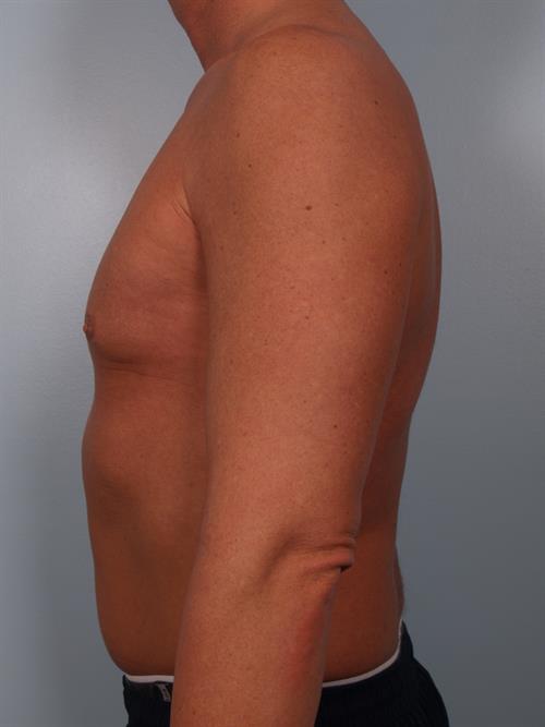 Male Breast/Areola Reduction After Photo | Phoenix and Scottsdale, AZ | Scottsdale Center for Plastic Surgery