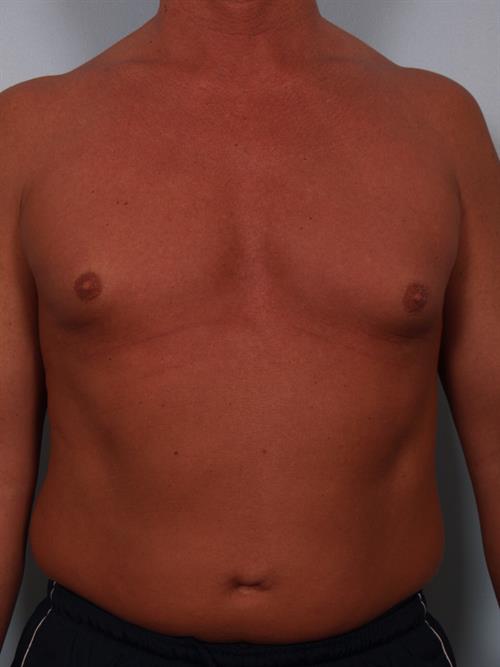 Male Breast/Areola Reduction Before Photo | Phoenix and Scottsdale, AZ | Scottsdale Center for Plastic Surgery