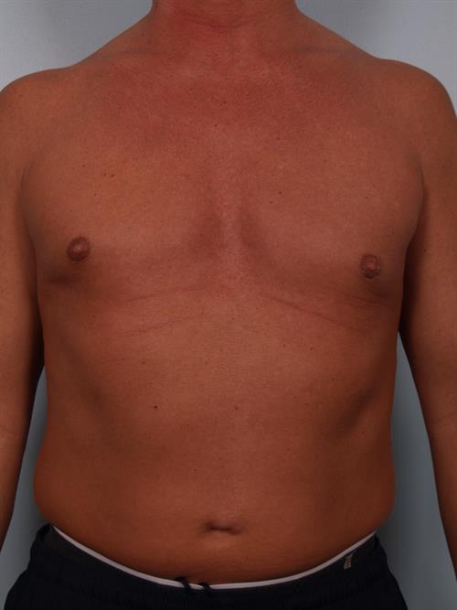Male Breast/Areola Reduction After Photo | Phoenix and Scottsdale, AZ | Scottsdale Center for Plastic Surgery