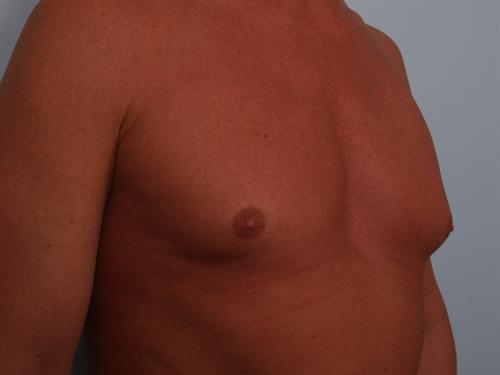 Male Breast/Areola Reduction Before Photo | Phoenix and Scottsdale, AZ | Scottsdale Center for Plastic Surgery