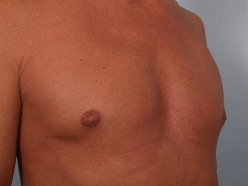 Male Breast/Areola Reduction After Photo | Phoenix and Scottsdale, AZ | Scottsdale Center for Plastic Surgery