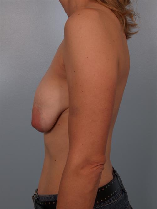 Revision Breast Surgery Before Photo | Phoenix and Scottsdale, AZ | Scottsdale Center for Plastic Surgery