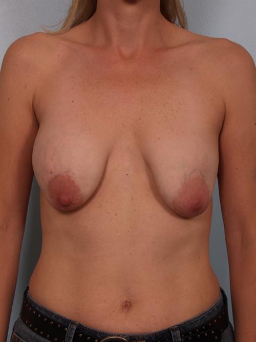 Revision Breast Surgery Before Photo | Phoenix and Scottsdale, AZ | Scottsdale Center for Plastic Surgery