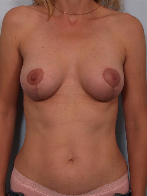 Revision Breast Surgery After Photo | Phoenix and Scottsdale, AZ | Scottsdale Center for Plastic Surgery