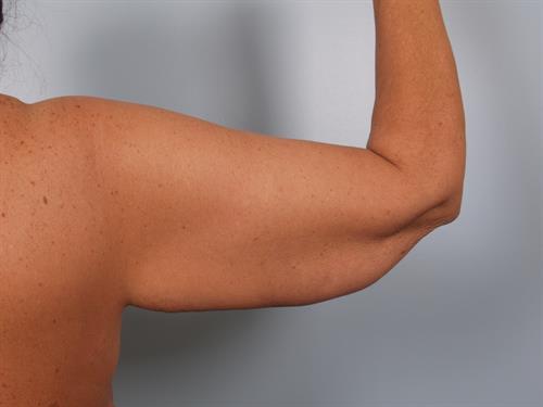Brachioplasty (Arm Lift) Before Photo | Phoenix and Scottsdale, AZ | Scottsdale Center for Plastic Surgery